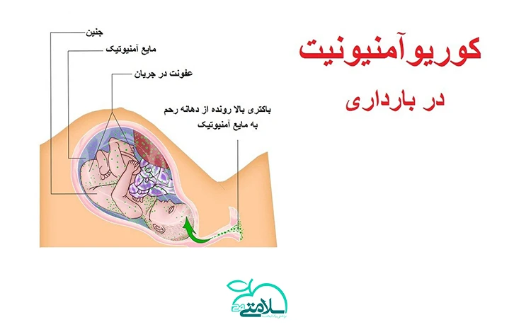 کوریوآمنیونیت یا عفونت کیسه آمنیوتیک